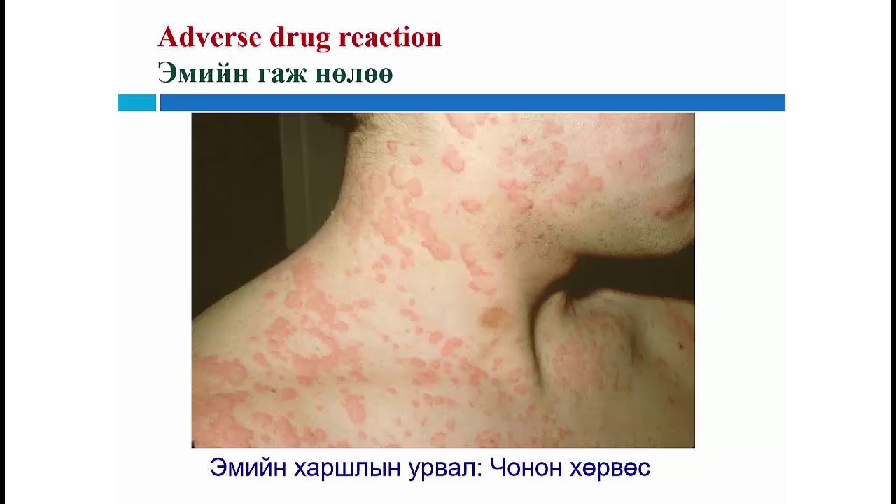 Лекц 4 Эмийн гаж нөлөөний талаар интерактив сургалтын гарын авлага ...
